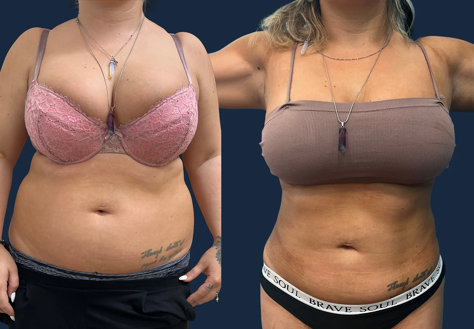 16_Beforeandafter+Dr_Ammar_Allouni